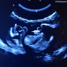 УЗИ молочных желез