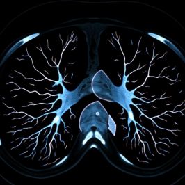 КТ легких и грудного отдела детям