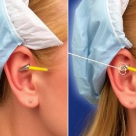 Продувание слуховых труб по Политцеру: Восстановление проходимости и слуха