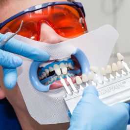 Особенности отбеливания зубов в стоматологии